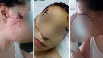 Barbarie: una patota le desfiguró el rostro a cuchillazos a una adolescente y detuvieron a dos menores
