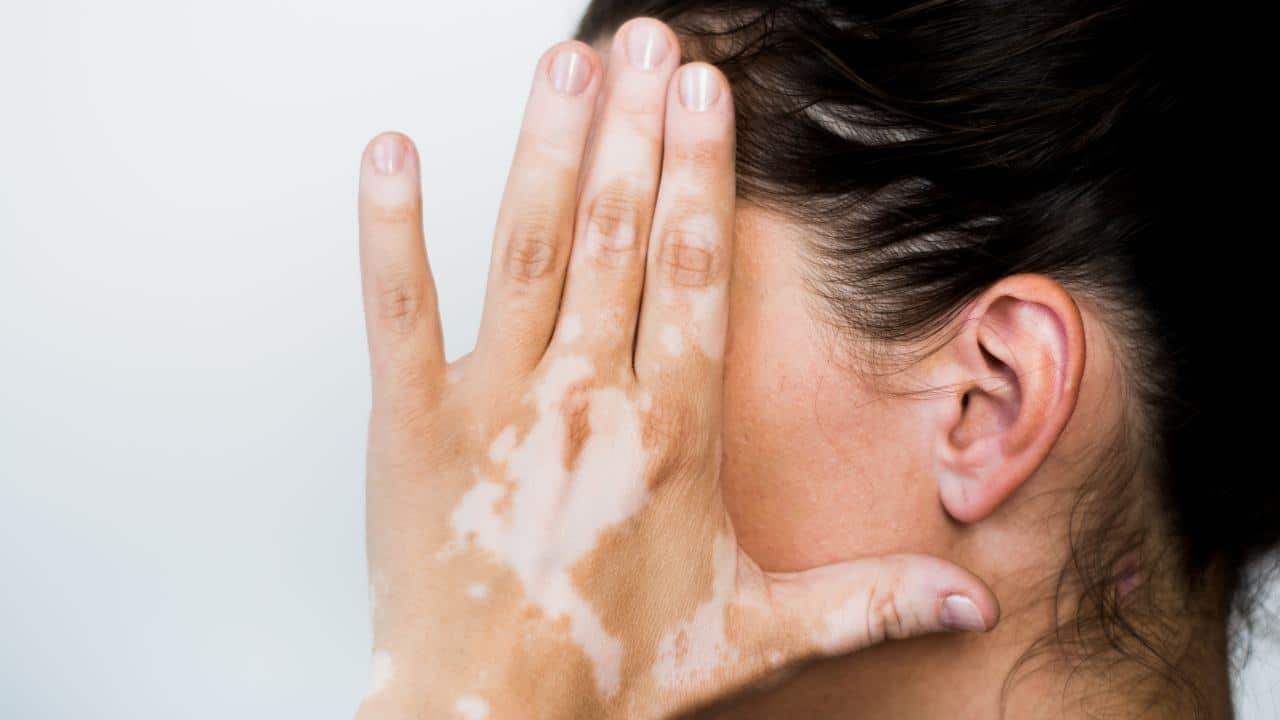Día Mundial del Vitiligo: qué es la enfermedad que provoca manchas blancas en la piel y cómo se trata